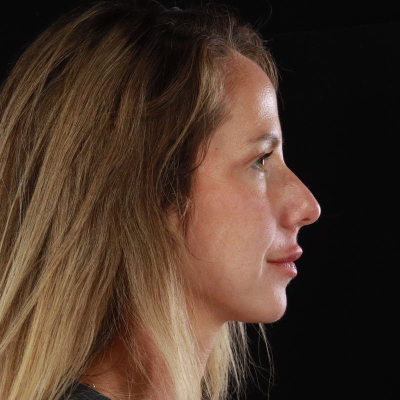 Dermal Fillers Before & After Gallery - Patient 189502 - Image 6