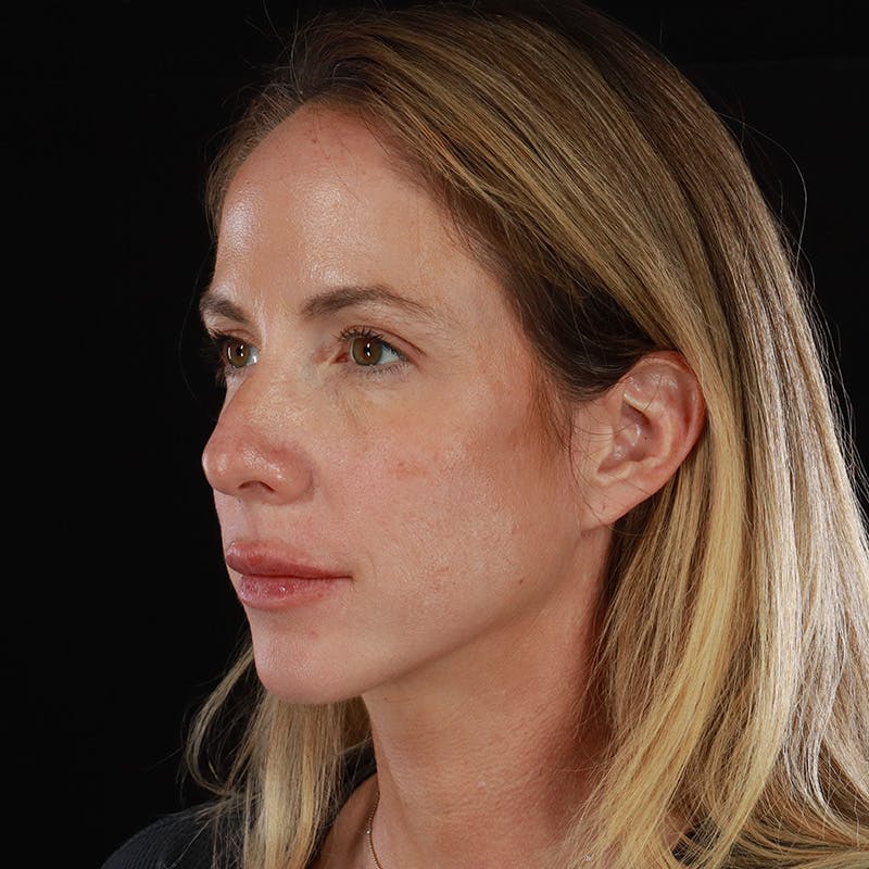 Dermal Fillers Before & After Gallery - Patient 189502 - Image 8