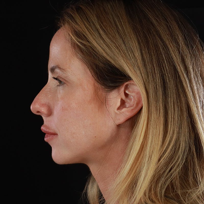 Dermal Fillers Before & After Gallery - Patient 189502 - Image 10