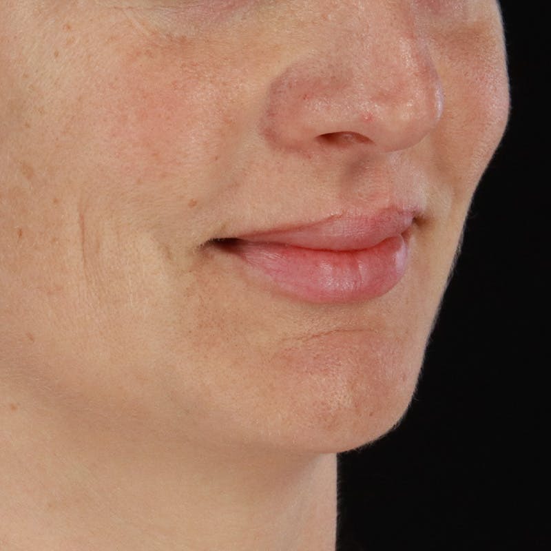Dermal Fillers Before & After Gallery - Patient 171174 - Image 1