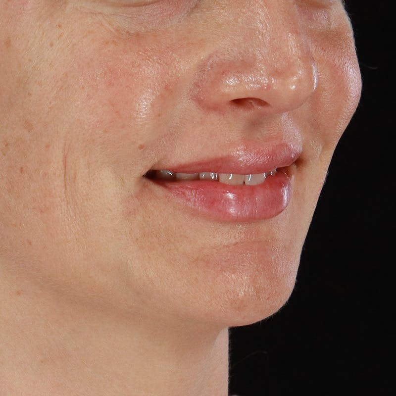 Dermal Fillers Before & After Gallery - Patient 171174 - Image 2