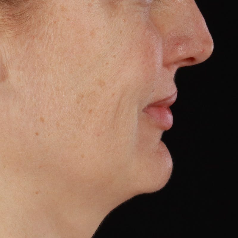 Dermal Fillers Before & After Gallery - Patient 171174 - Image 3
