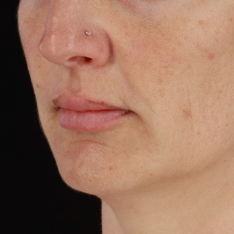 Dermal Fillers Before & After Gallery - Patient 171174 - Image 5