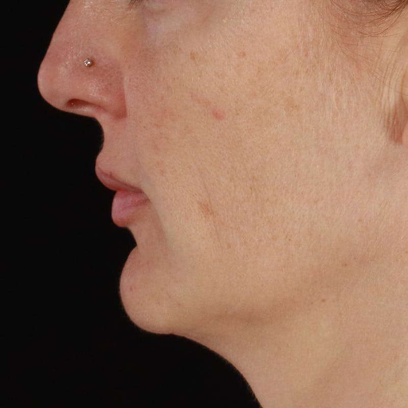 Dermal Fillers Before & After Gallery - Patient 171174 - Image 7