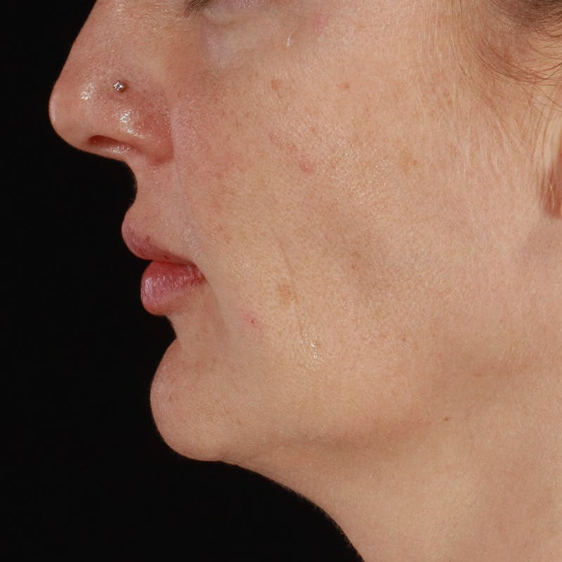 Dermal Fillers Before & After Gallery - Patient 171174 - Image 8