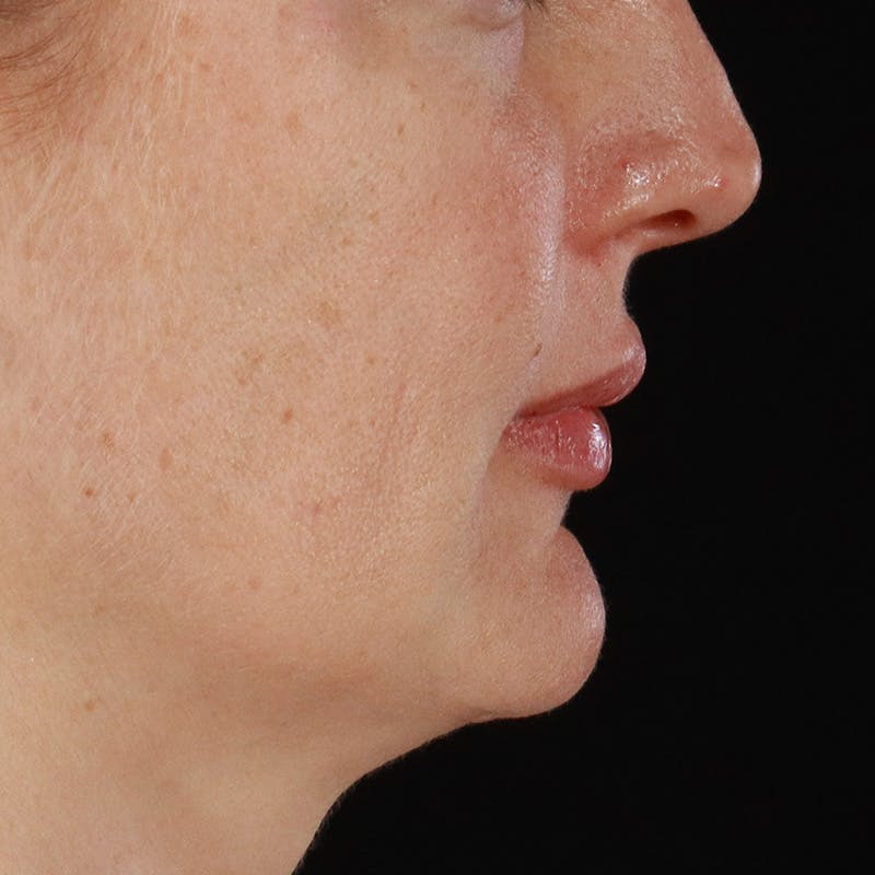 Dermal Fillers Before & After Gallery - Patient 171174 - Image 4