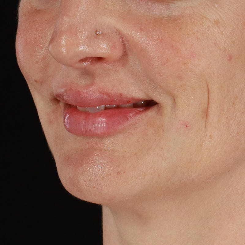 Dermal Fillers Before & After Gallery - Patient 171174 - Image 6