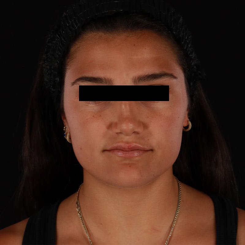 Dysport Before & After Gallery - Patient 532552 - Image 3