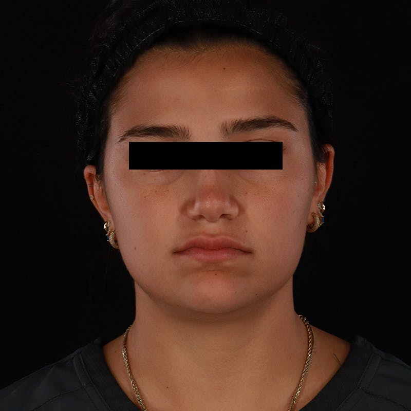 Dysport Before & After Gallery - Patient 532552 - Image 4