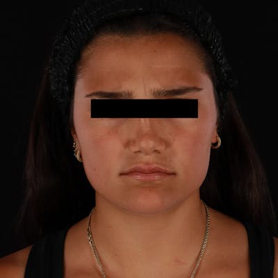Dysport Before & After Gallery - Patient 532552 - Image 1
