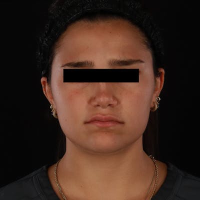 Dysport Before & After Gallery - Patient 532552 - Image 2