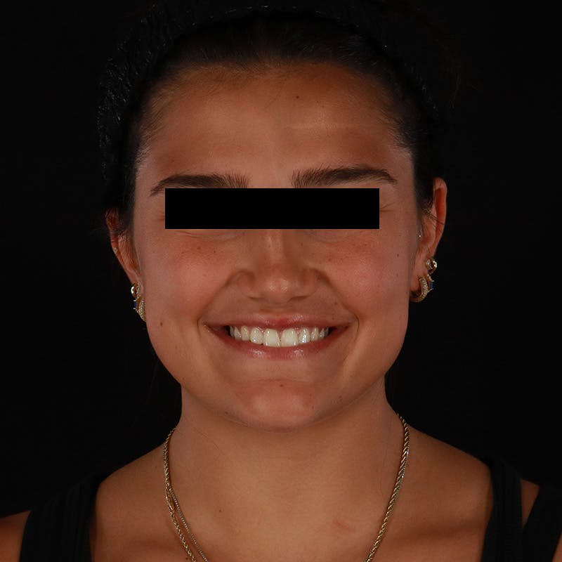 Dysport Before & After Gallery - Patient 532552 - Image 5