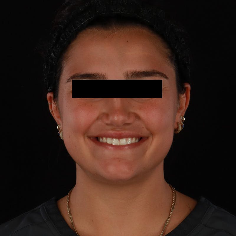 Dysport Before & After Gallery - Patient 532552 - Image 6