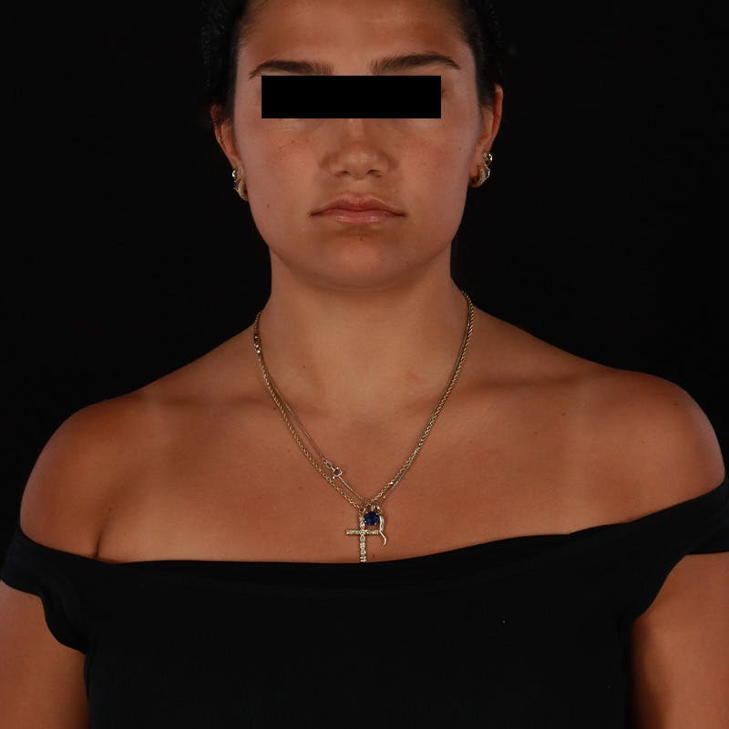 Dysport Before & After Gallery - Patient 532552 - Image 8