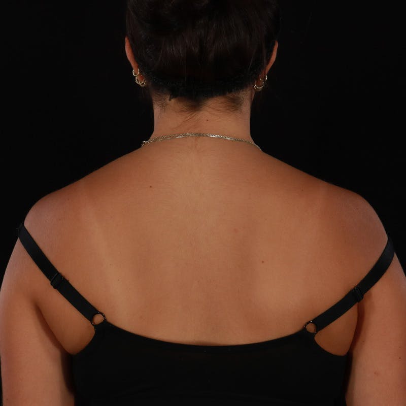 Dysport Before & After Gallery - Patient 532552 - Image 10