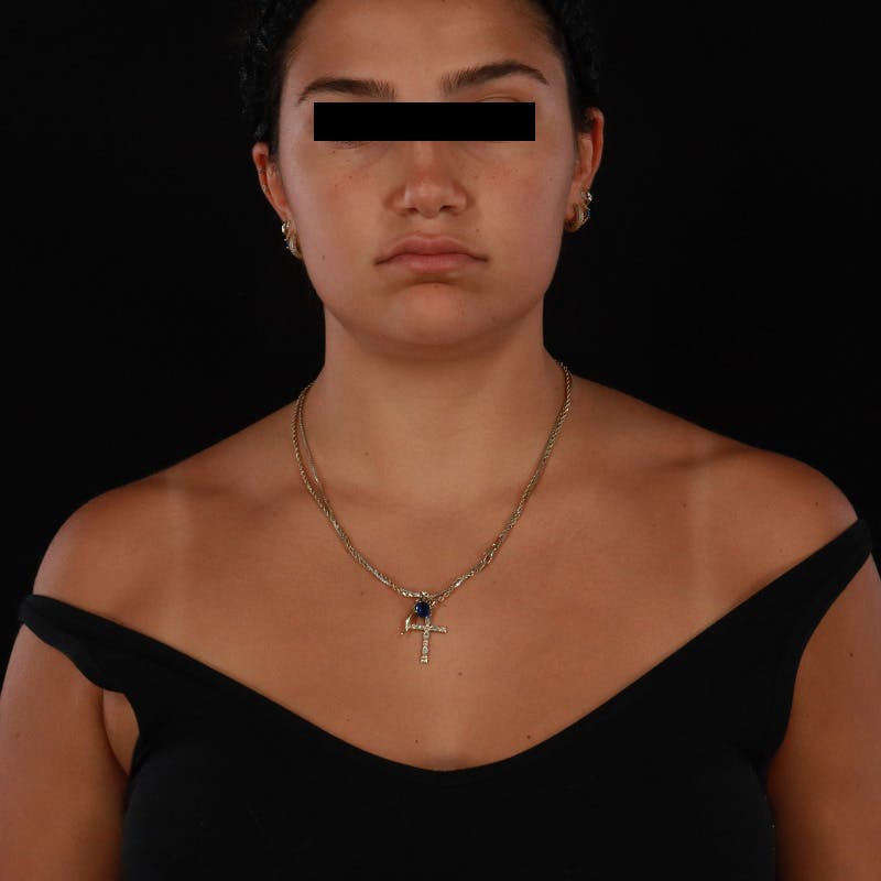 Dysport Before & After Gallery - Patient 532552 - Image 7