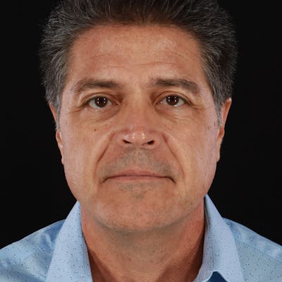 Dysport Before & After Gallery - Patient 442615 - Image 1