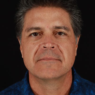 Dysport Before & After Gallery - Patient 442615 - Image 2