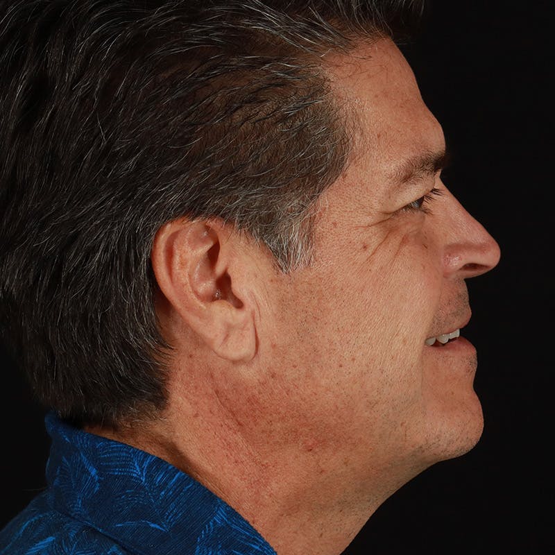 Dysport Before & After Gallery - Patient 442615 - Image 12