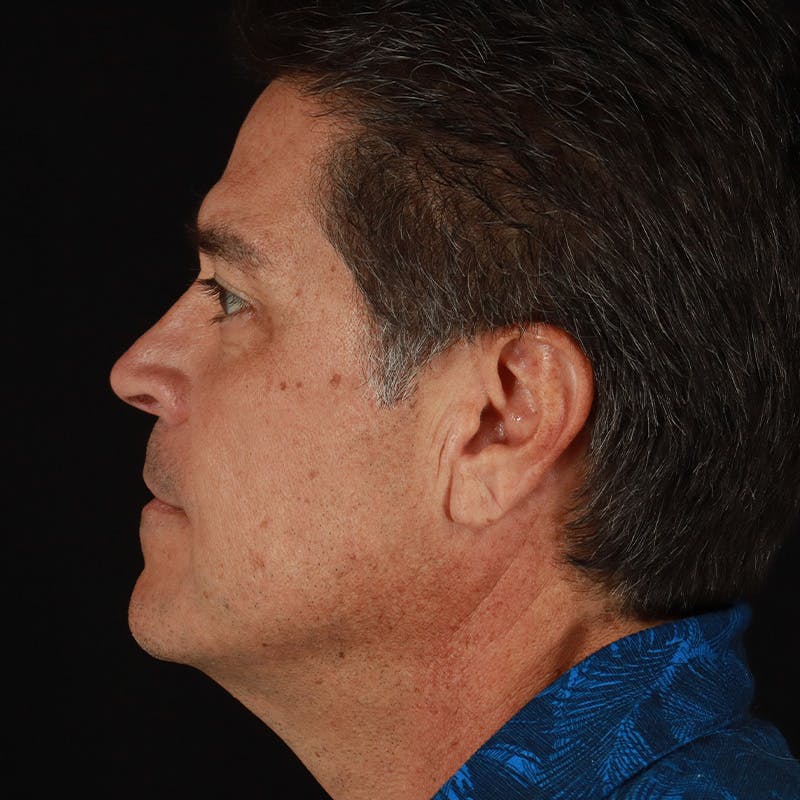 Dysport Before & After Gallery - Patient 442615 - Image 18