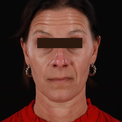 Dysport Before & After Gallery - Patient 278582 - Image 1