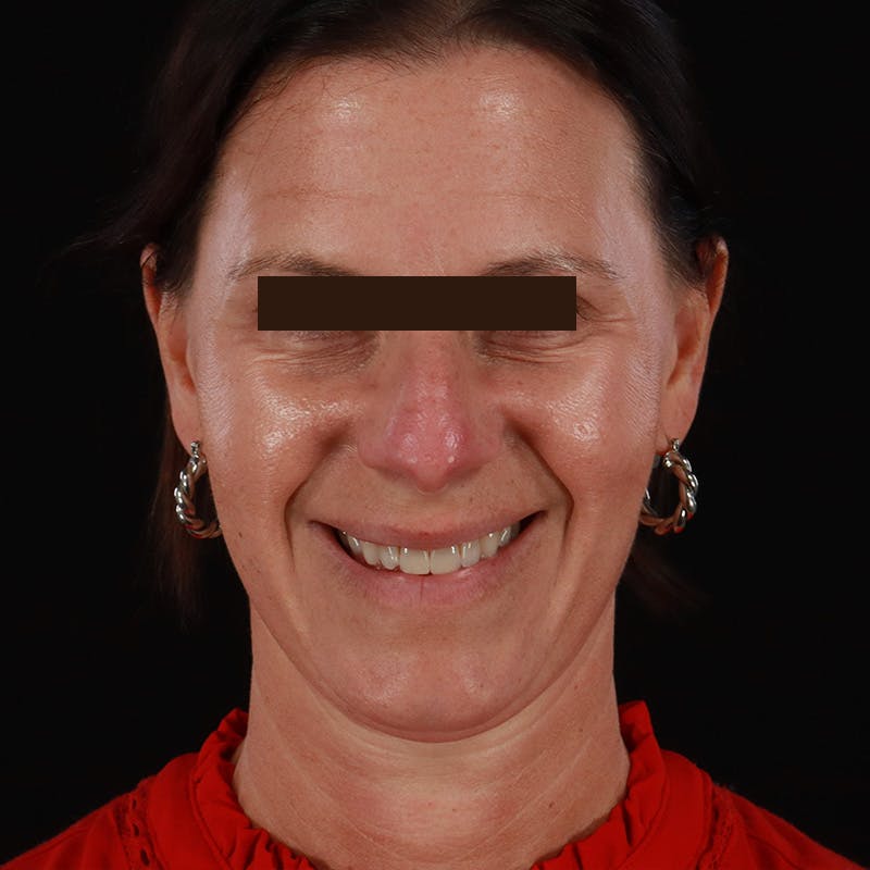 Dysport Before & After Gallery - Patient 278582 - Image 3