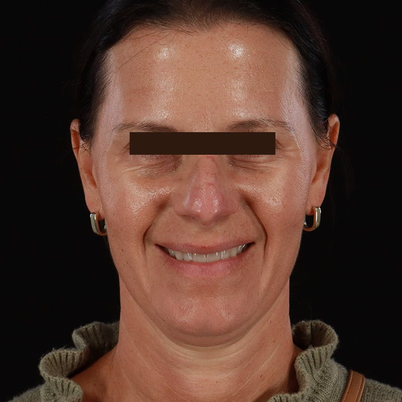 Dysport Before & After Gallery - Patient 278582 - Image 4