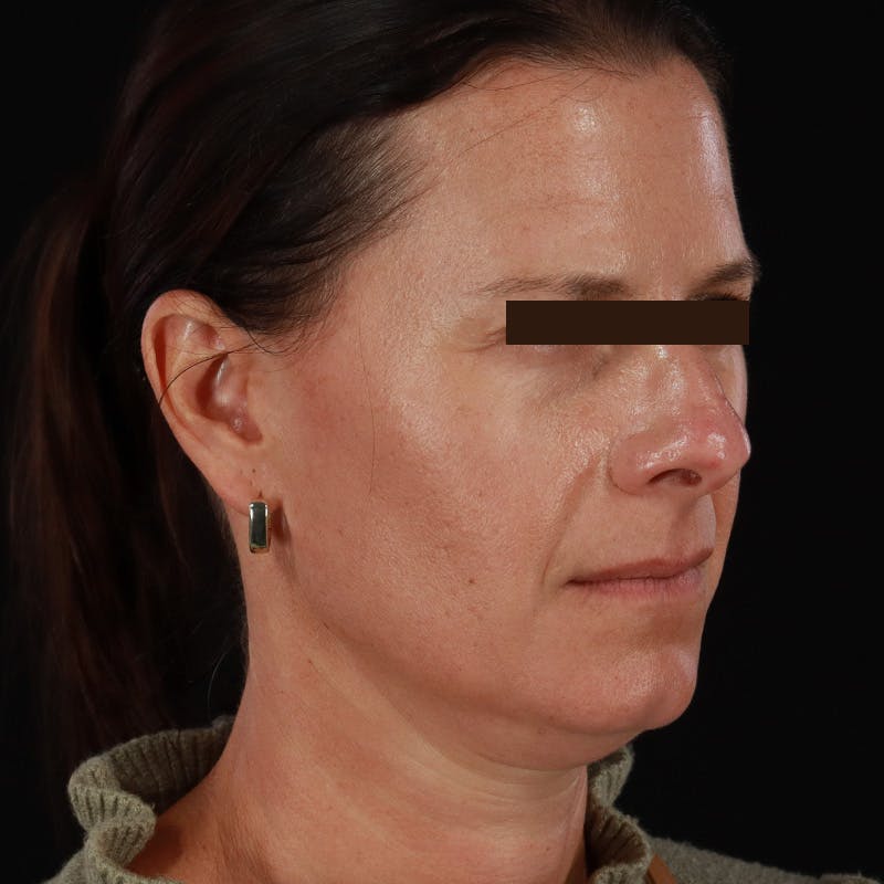 Dysport Before & After Gallery - Patient 278582 - Image 12