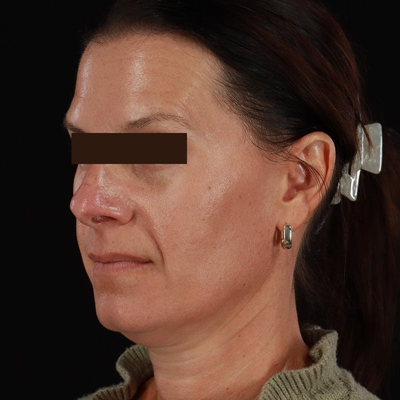 Dysport Before & After Gallery - Patient 278582 - Image 16