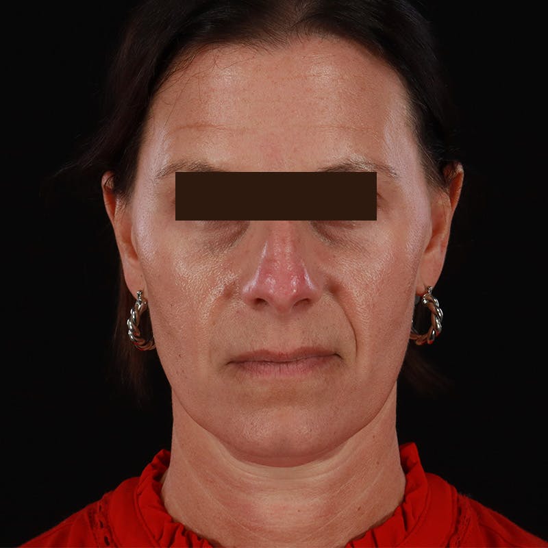 Dysport Before & After Gallery - Patient 278582 - Image 7