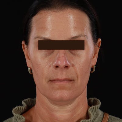 Dysport Before & After Gallery - Patient 278582 - Image 2