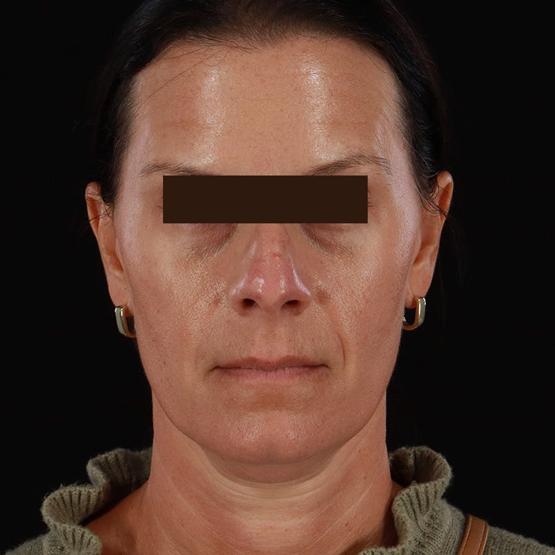 Dysport Before & After Gallery - Patient 278582 - Image 8