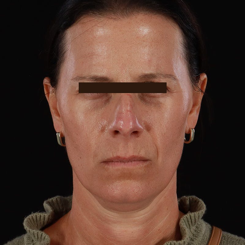 Dysport Before & After Gallery - Patient 278582 - Image 6