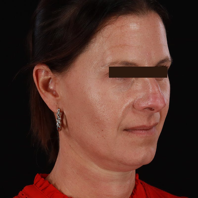 Dysport Before & After Gallery - Patient 278582 - Image 9
