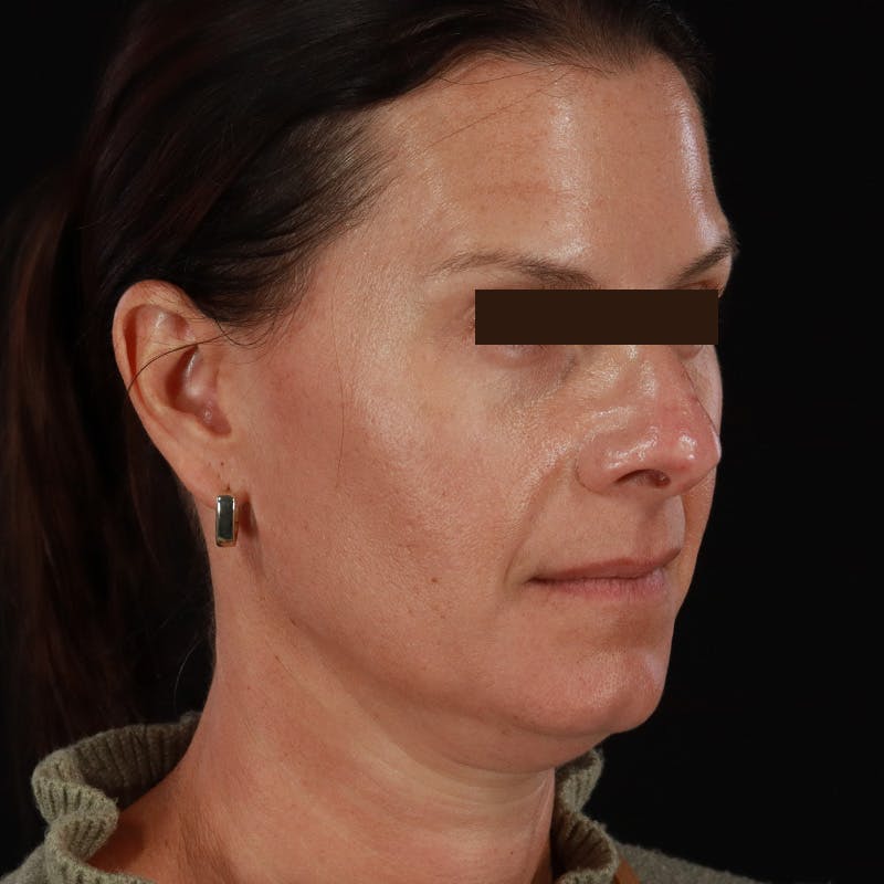 Dysport Before & After Gallery - Patient 278582 - Image 10