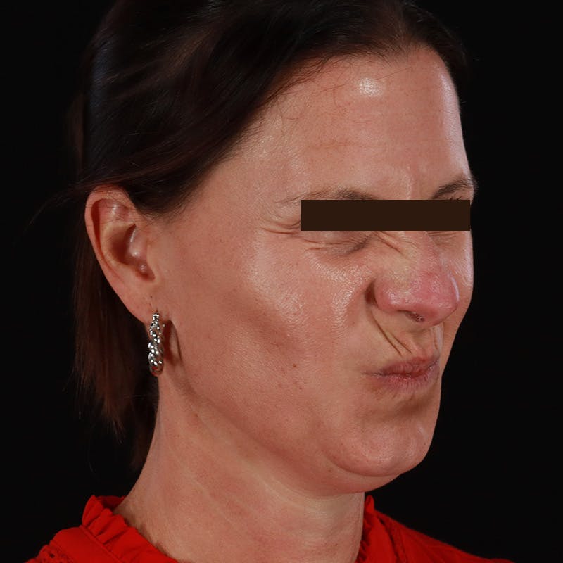 Dysport Before & After Gallery - Patient 278582 - Image 11