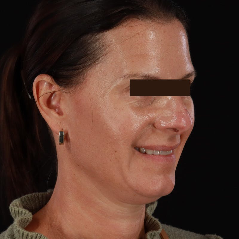 Dysport Before & After Gallery - Patient 278582 - Image 14