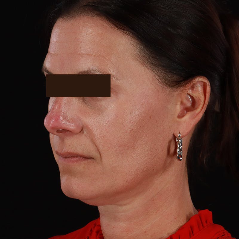 Dysport Before & After Gallery - Patient 278582 - Image 15