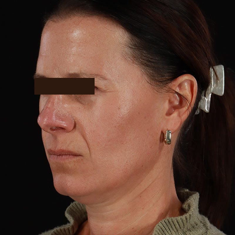 Dysport Before & After Gallery - Patient 278582 - Image 18