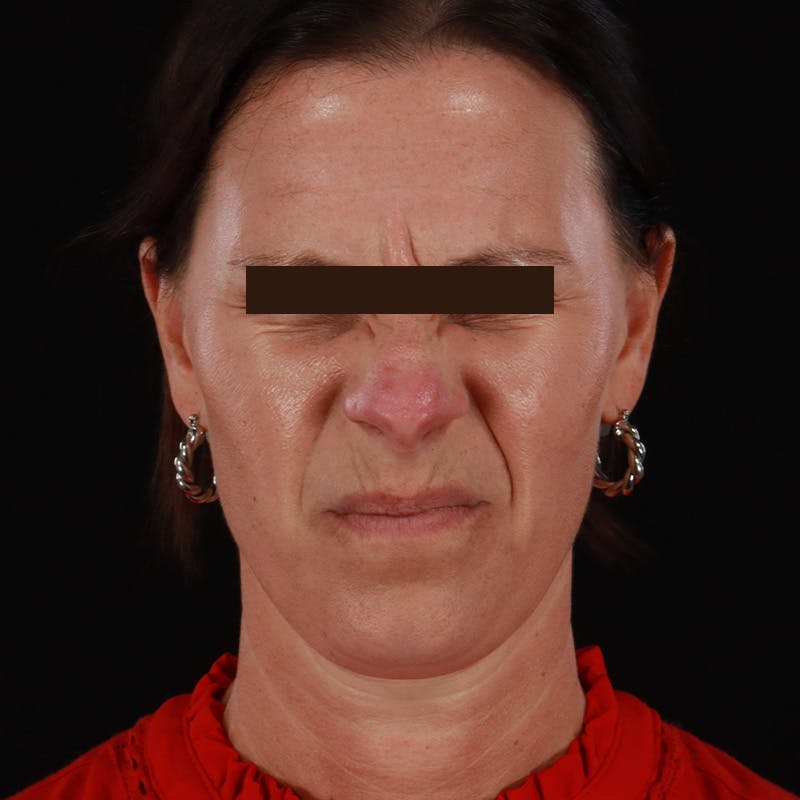 Dysport Before & After Gallery - Patient 278582 - Image 5