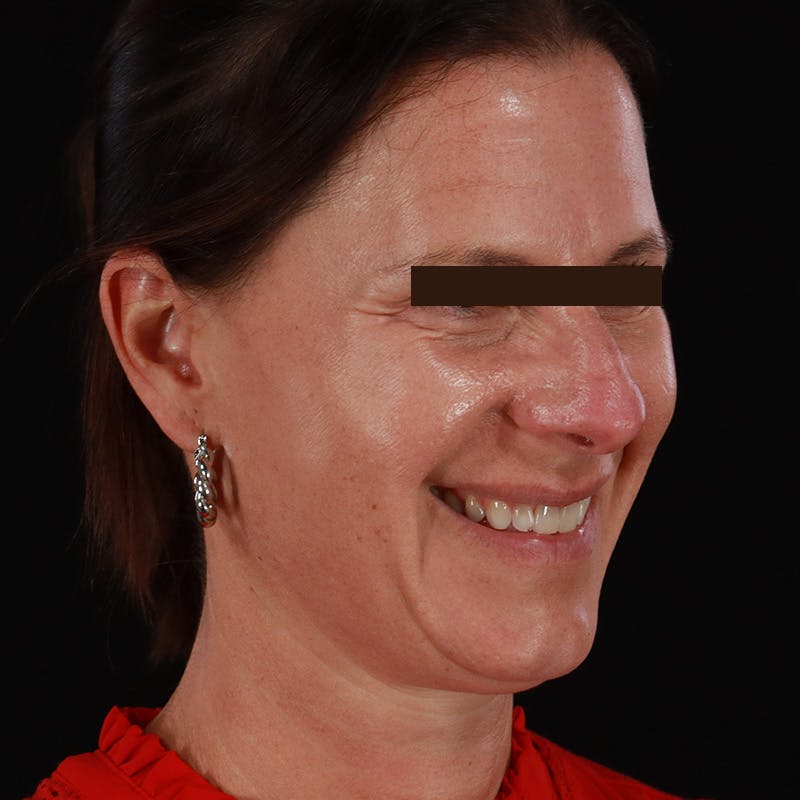 Dysport Before & After Gallery - Patient 278582 - Image 13