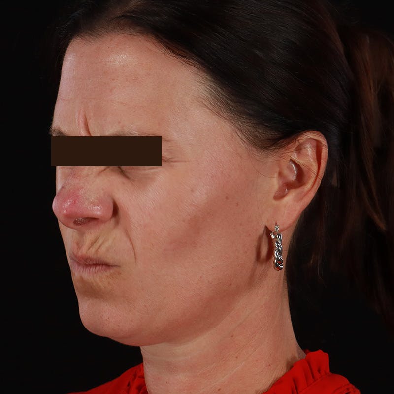 Dysport Before & After Gallery - Patient 278582 - Image 17