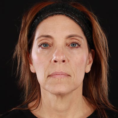 Dysport Before & After Gallery - Patient 234835 - Image 1