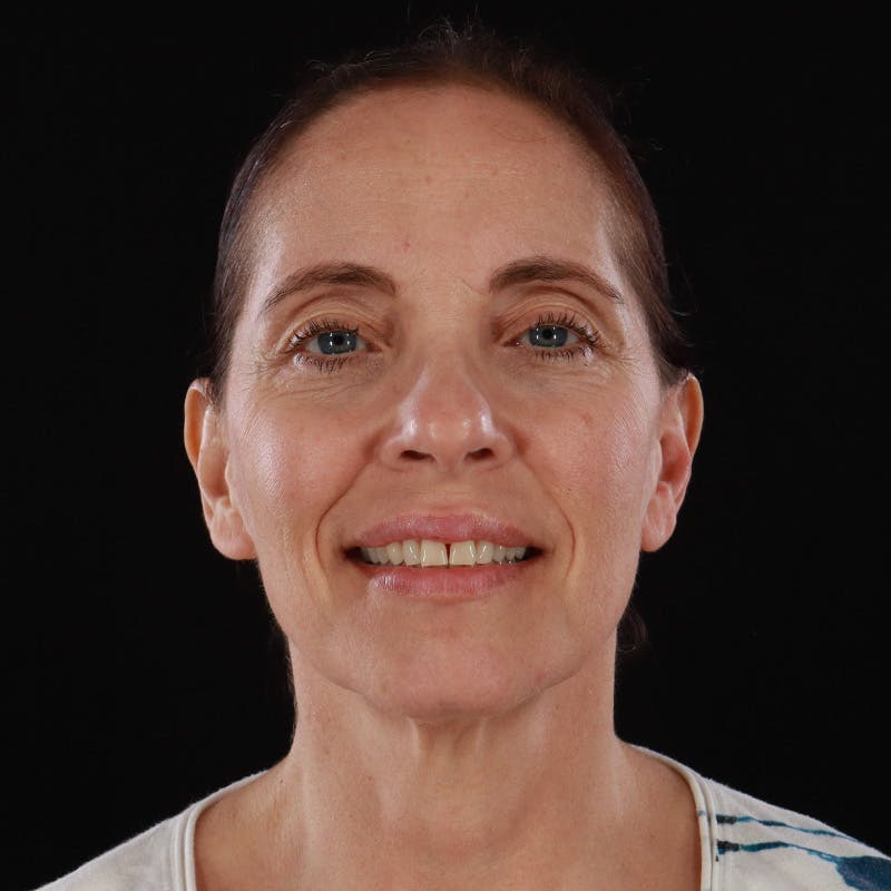 Dysport Before & After Gallery - Patient 234835 - Image 4