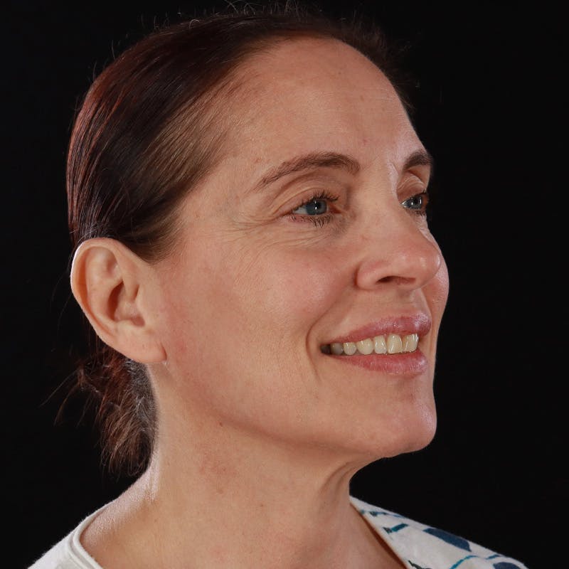Dysport Before & After Gallery - Patient 234835 - Image 6