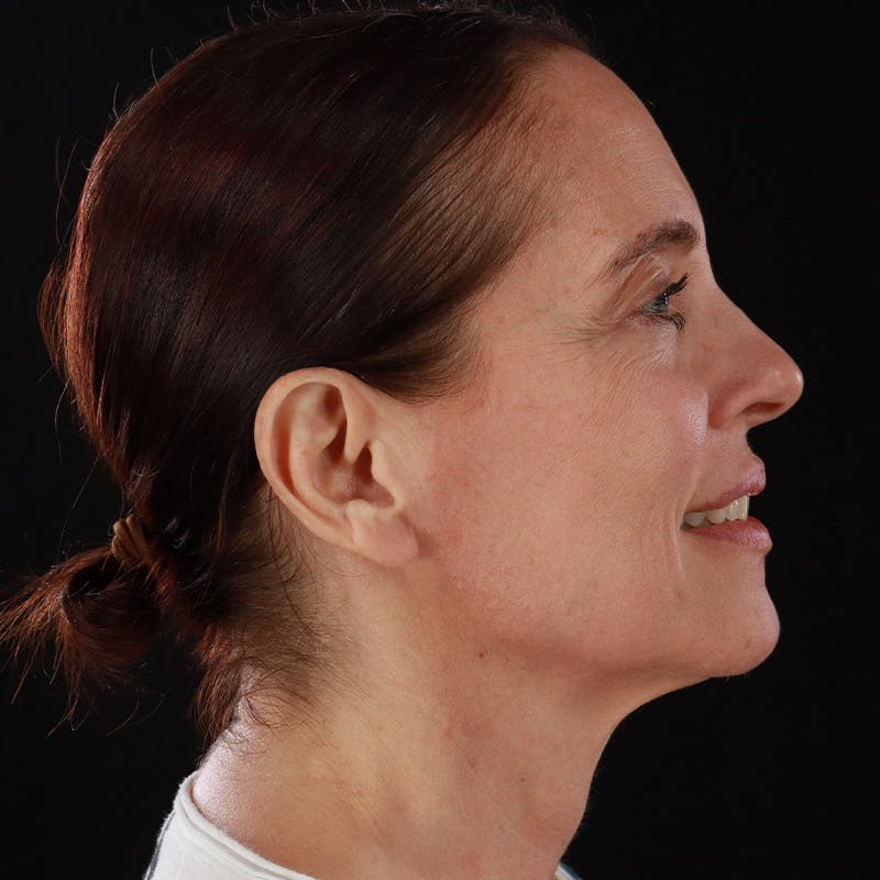 Dysport Before & After Gallery - Patient 234835 - Image 8