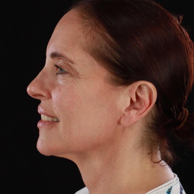 Dysport Before & After Gallery - Patient 234835 - Image 12