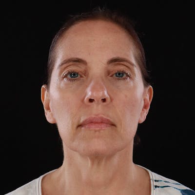 Dysport Before & After Gallery - Patient 234835 - Image 2