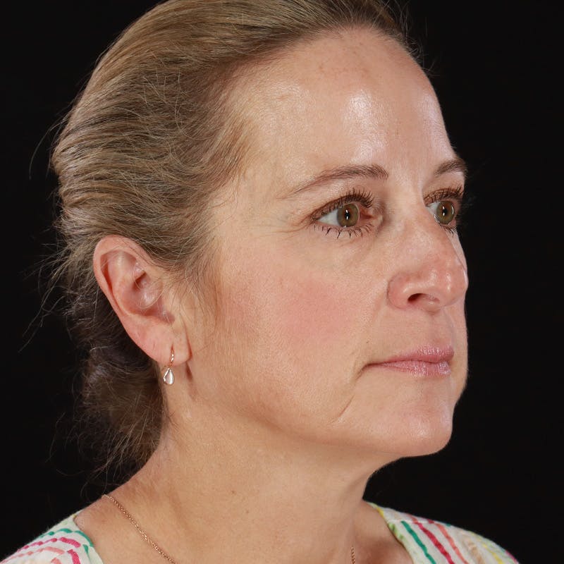 Dysport Before & After Gallery - Patient 239818 - Image 8