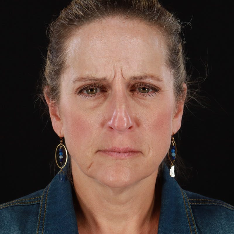Dysport Before & After Gallery - Patient 239818 - Image 3